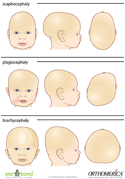 Kiddie Cranials | Prosthetic Orthotic Designs